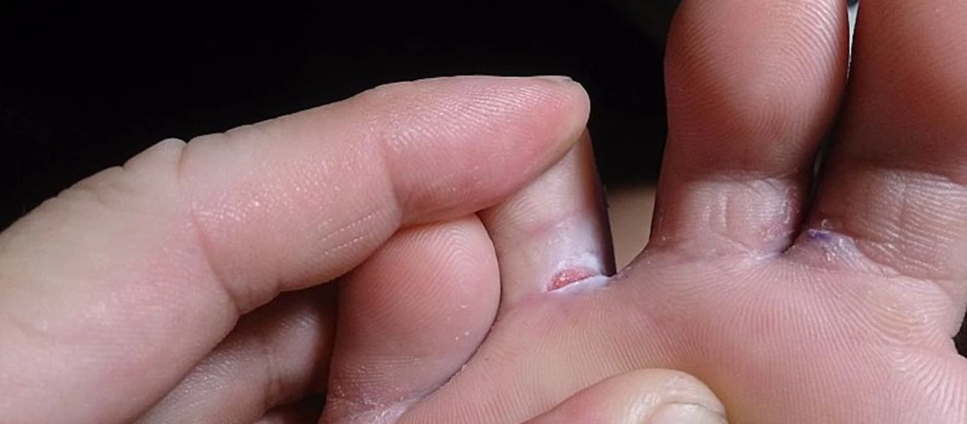 Το σούπερ ελιξίριο που διώχνει τους μύκητες των ποδιών μια για πάντα